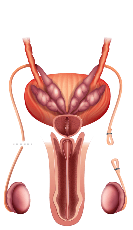 Reversão de vasectomia