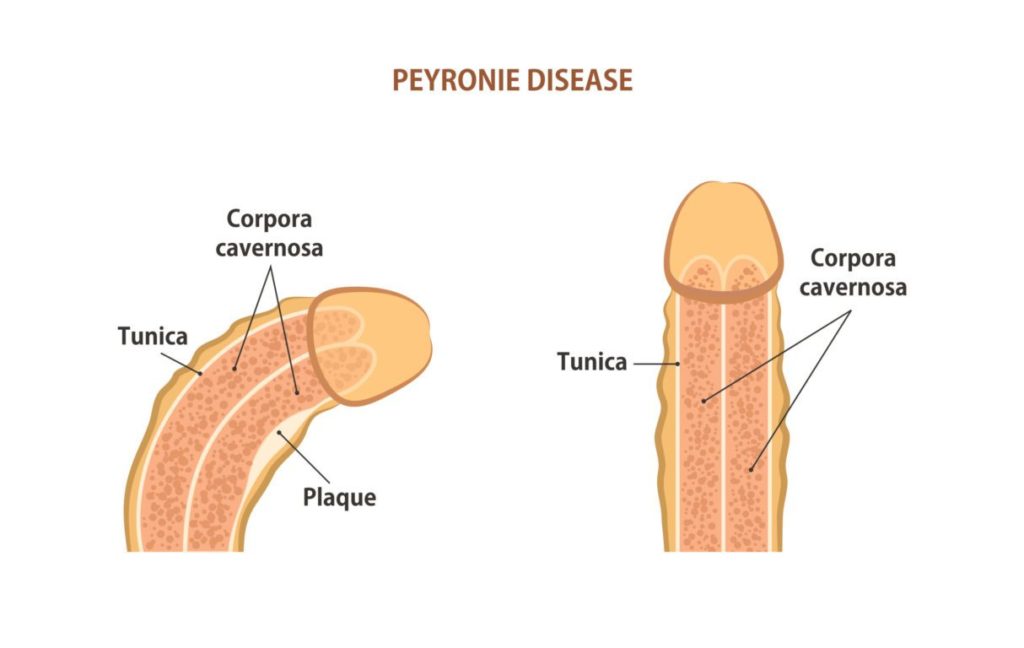 Peyronie