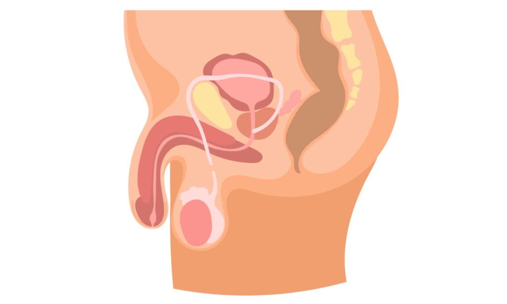 reversão de vasectomia falhou