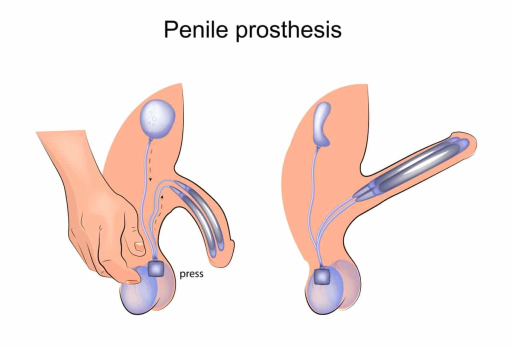 prótese peniana aumenta