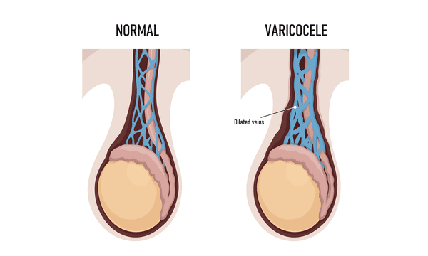 microcirurgia de varicocele