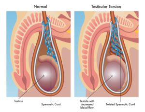 Imagem ilustrativa do que é varicocele