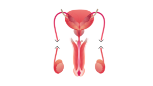 Imagem ilustrativa da reversão da vasectomia